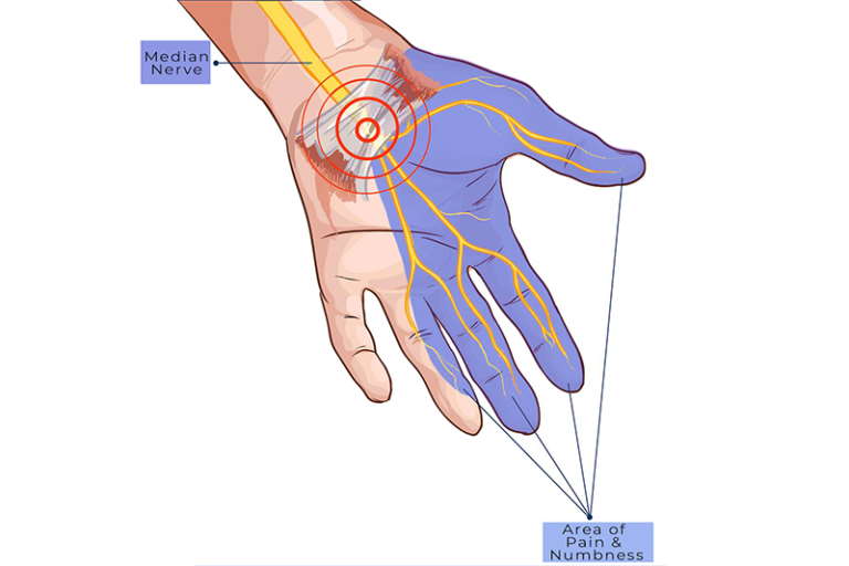 Carpal Tunnel Stretches | Physcial Therapy by SOC